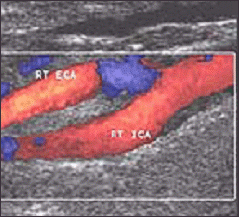 Vein Ultrasound