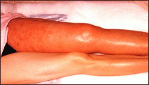 Vein Disease